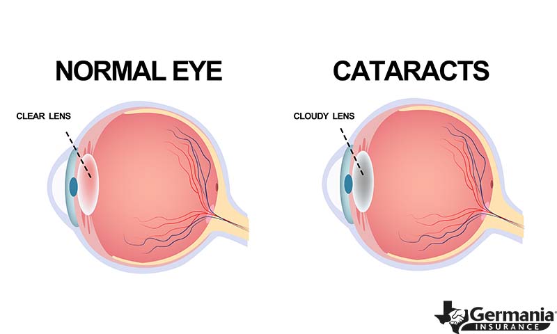 A diagram of cataracts