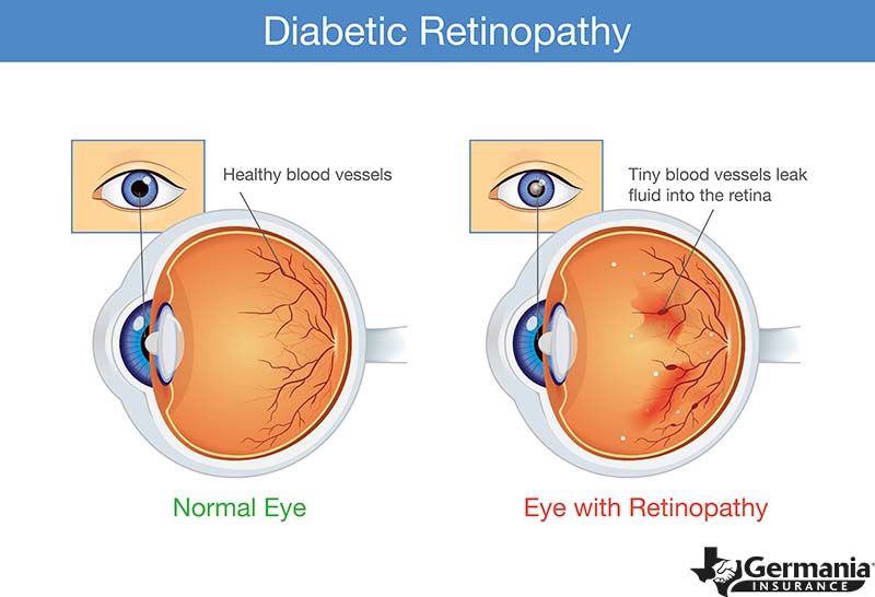 How To Spot 6 Of The Most Common Eye Disorders And Diseases